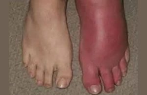 What Does It Mean When One Leg Suddenly Turns Red and Swollen?