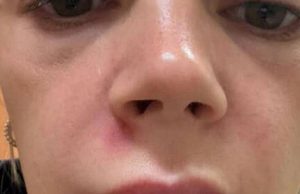 Woman hospitalised after popping spot in her ‘triangle of d.e.ath’