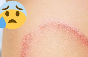 How to identify and cure skin fungus or ringworm.