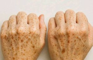 The Truth About Age Spots: When They’re Normal and When to See a Doctor