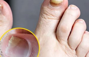 Health Expert Reveals Warning Signs of Two Silent Foot K.ill.ers and How To Spot Them